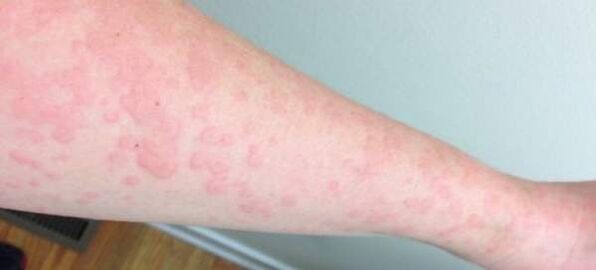 Alergiile cutanate sunt un semn al prezenței paraziților în organism